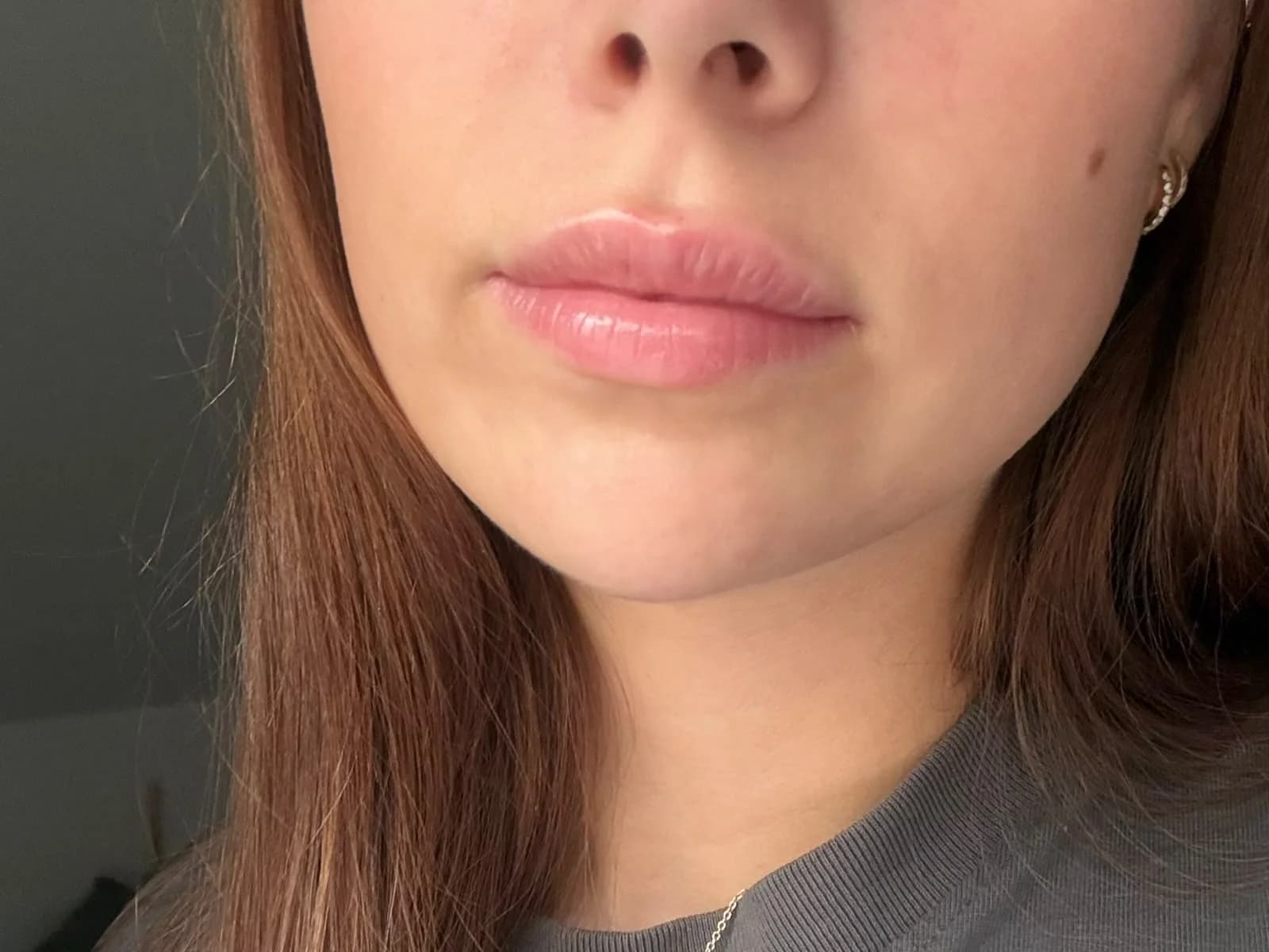 Lippen nach dem Lippenaufbau bei Vanessa