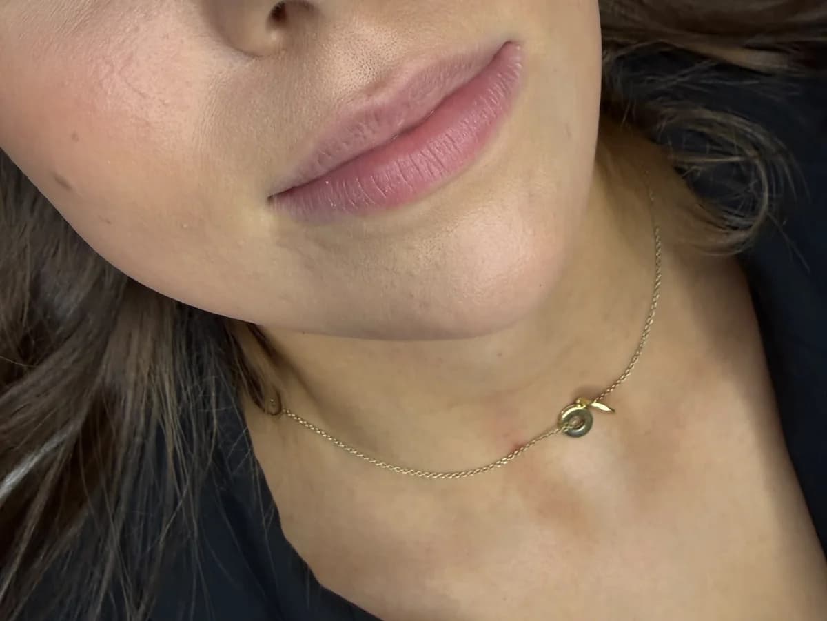 Lippen vor dem Lippenaufbau bei Vanessa